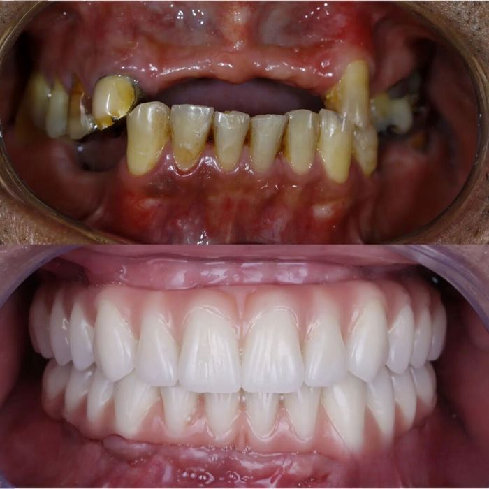 Dentadura de Silicone FIX | Ajustavel e Adaptativa Saúde & Bem-Estar (Dentaduras 1) Lojas Quinho 